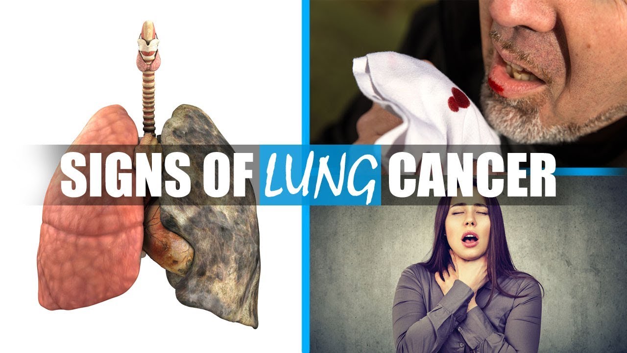 Symptoms Of Lung Cancer What Are Early Signs Of Lung Cancer You