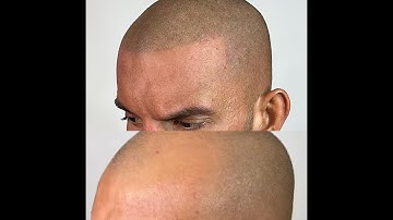 Scalp Micro Pigmentation for Men | Get the Look of a Full Head of Hair