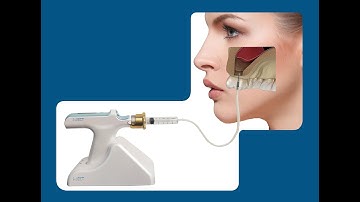 i-JECT DSL(Digital Sinus Lift) kit video