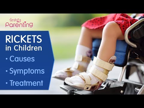 Video: Diagnosis Of Rickets In Infants