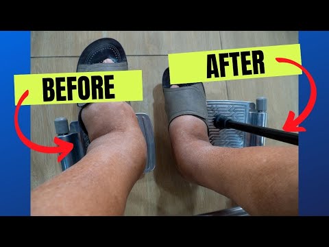 Video: Hur man behandlar svullna fotleder och fötter för lupus nefrit: 14 steg