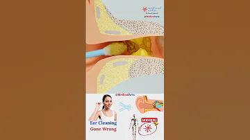 Ear Wax Cleaning By Cotton Swab Gone Wrong 