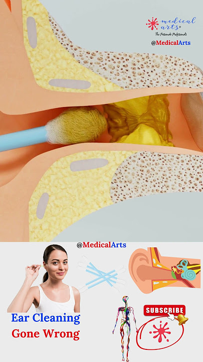 Ear Wax Cleaning by Cotton Swab 👂 Gone Wrong!