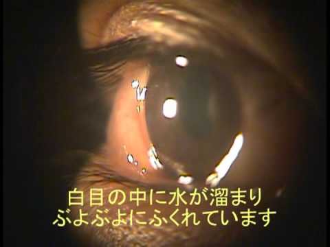 目薬 結膜 浮腫