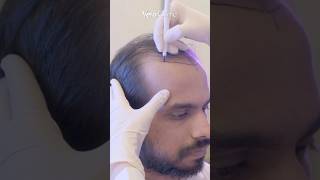 Hair Transplant Turkey Surgery #hairtransplantistanbul #hairtransplantturkey #hairtransplantreview