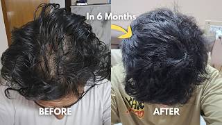 How To Stop Hair Thinning (Reverse Your Hair loss) Using Minoxidil