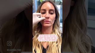 Lip Flips! #lipflip #botox #lipfillers