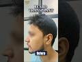 Struggling with a patchy or thin beard? #hairtransplant #beardtransplant #sharvaclinic #trending