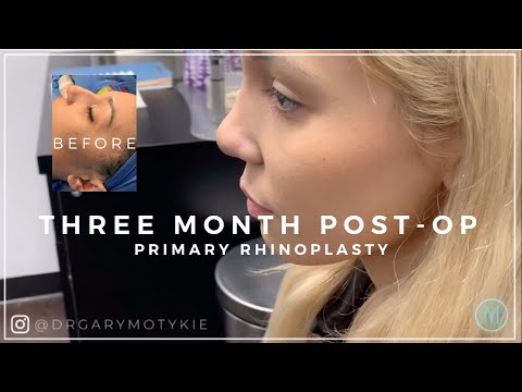 Video thumbnail: RHINOPLASTY RECOVERY: 3 MONTHS POST-OP · Dr. Gary Motykie
