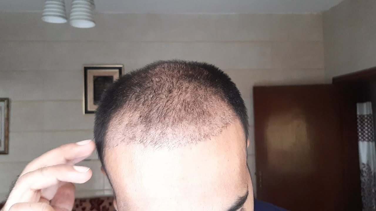 Hair shedding after a hair transplant | Hair Center Mexico