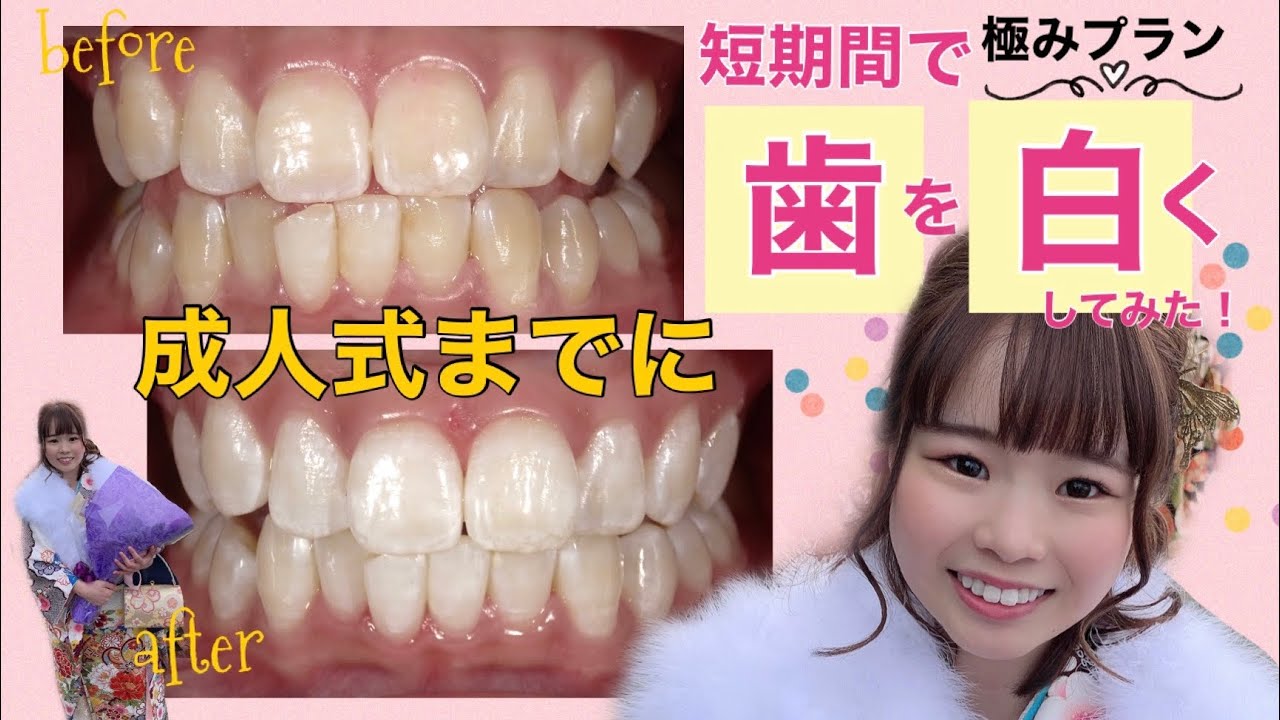 白い歯であなたの第一印象が変わる 短時間 美容歯科モニター募集 美容整形 美容外科の湘南美容クリニック