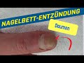 Nagelbettentzündung am Daumen durch NAGELKAUEN  oder REISSEN