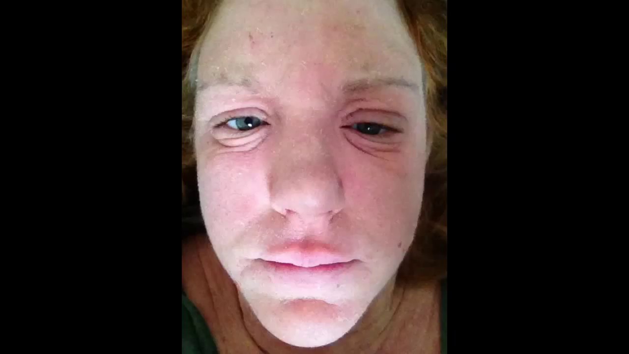 Topical Steroid Withdrawal My Experience YouTube