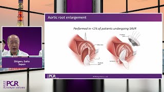 The importance of hemodynamic performance in transcatheter aortic valves - Webinar