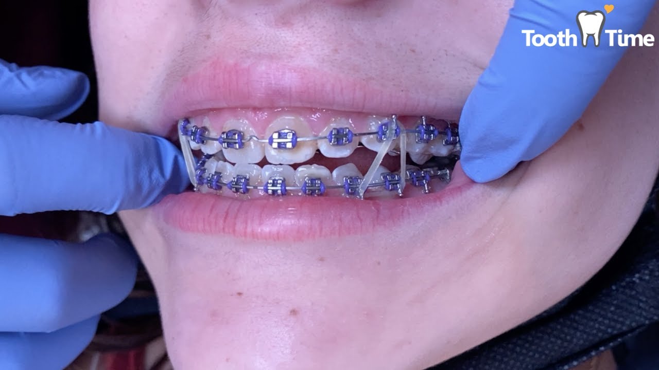 Rubber Band Tips For Orthodontic Patients - Orthodontist Dublin and Gahanna