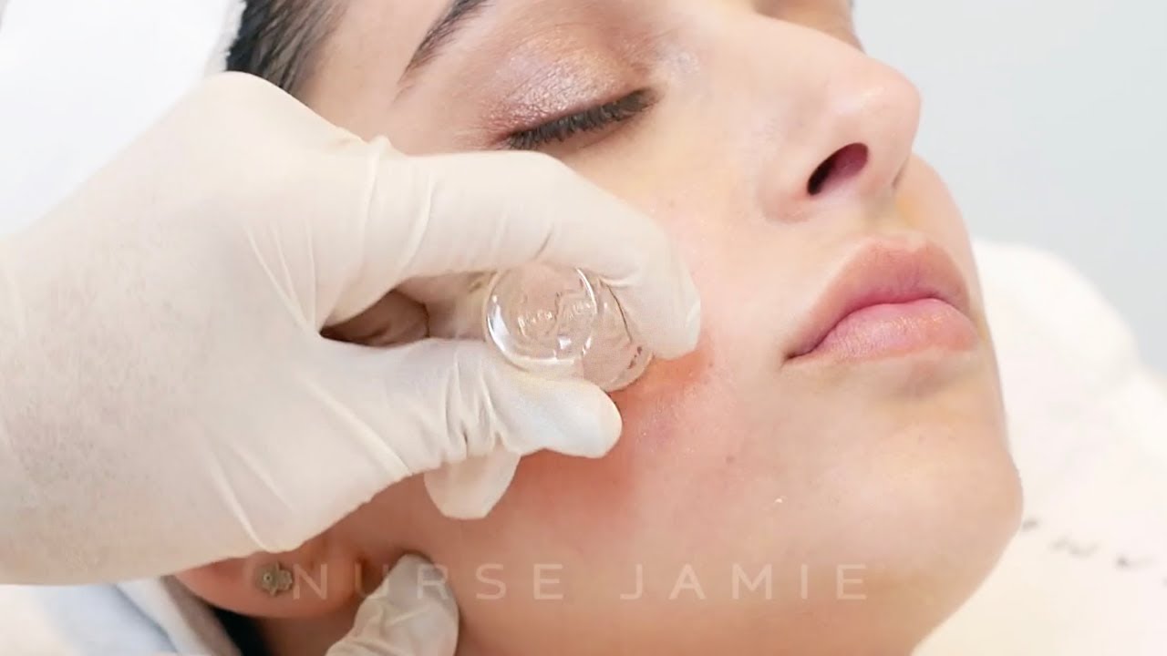 Microdosing Beauty Treatment | Nurse Jamie