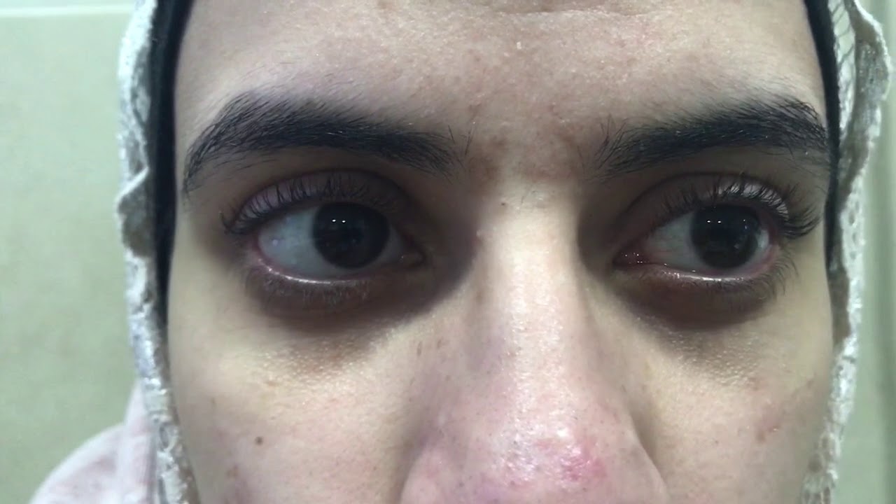 Congenital Nystagmus YouTube