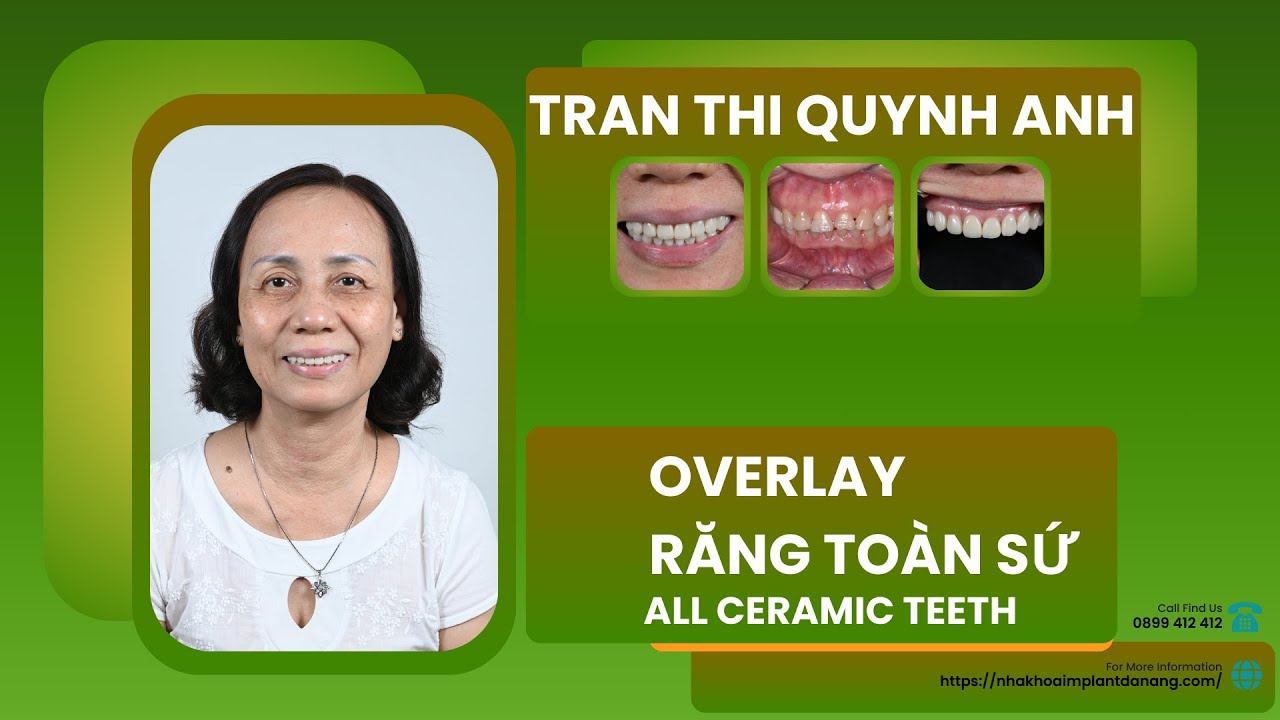 [FEEDBACK] Trám răng Overlay - Giải pháp tốt nhất giúp bạn phục hồi ...