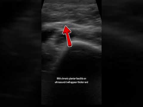 Diagnostic Ultrasound Plantar Fasciitis