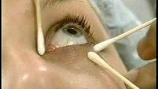 Chemical Peel, most effective tool to make skin look younger
