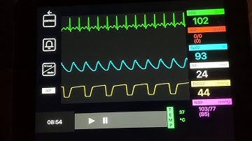 baseline ecg