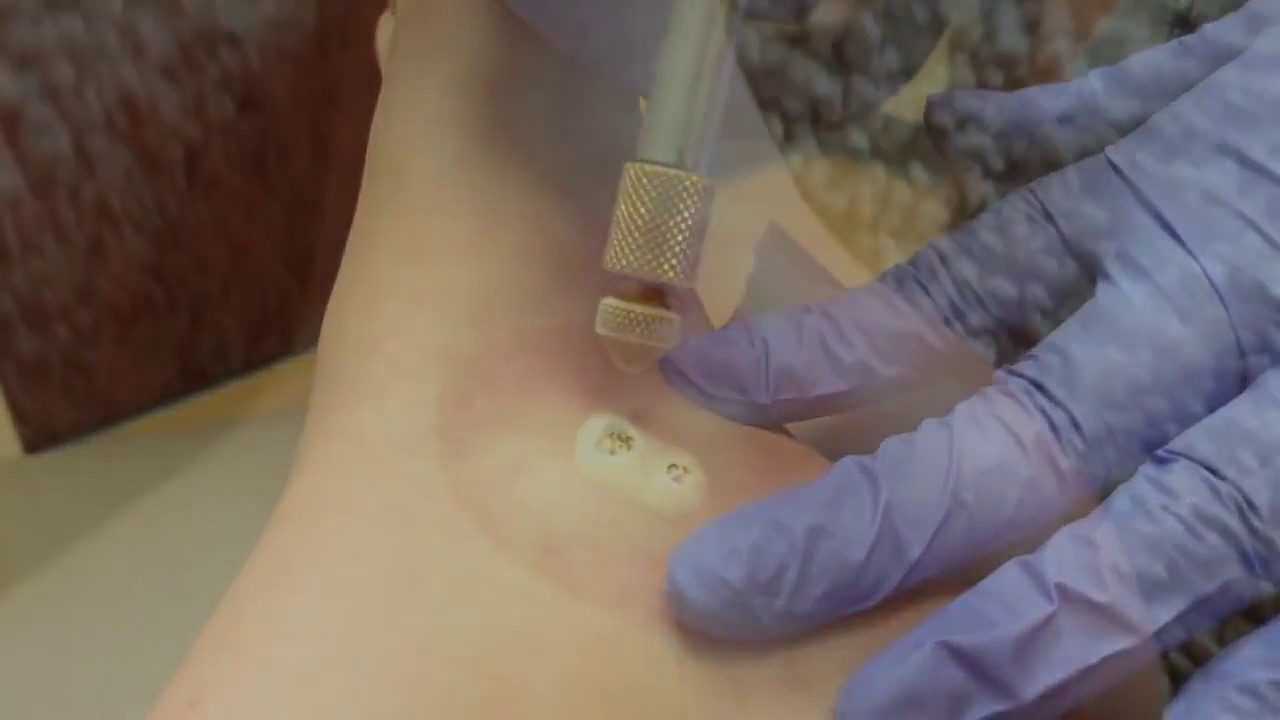 Бородавки на ногах. Удаление бородавки. Удаление бородавки азотом - YouTube