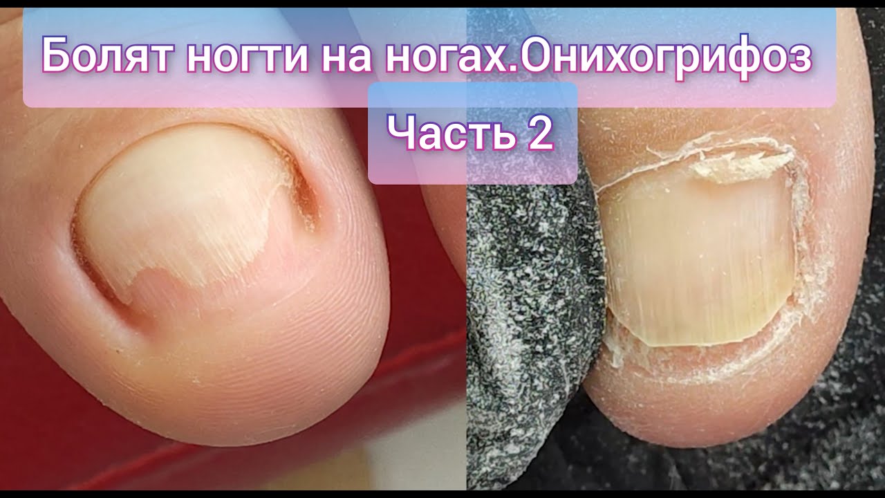 БОЛЯТ НОГТИ НА НОГАХ. ОНИХОГРИФОЗ И ОНИХОЛИЗИС. ВОССТАНОВЛЕНИЕ НОГТЕЙ ...