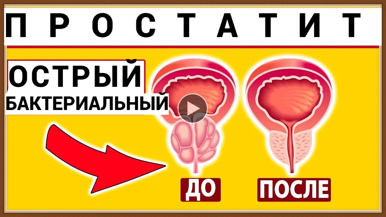 Простатит канал. Острый бактериальный простати. бактериальный простатит. острый бактериальный простатит.