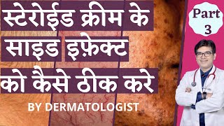 Steroid Creams Side Effects Treatment In Hindi । स्टेरोईड क्रीम्स के साइड इफ़ेक्ट्स को कैसे ठीक करे