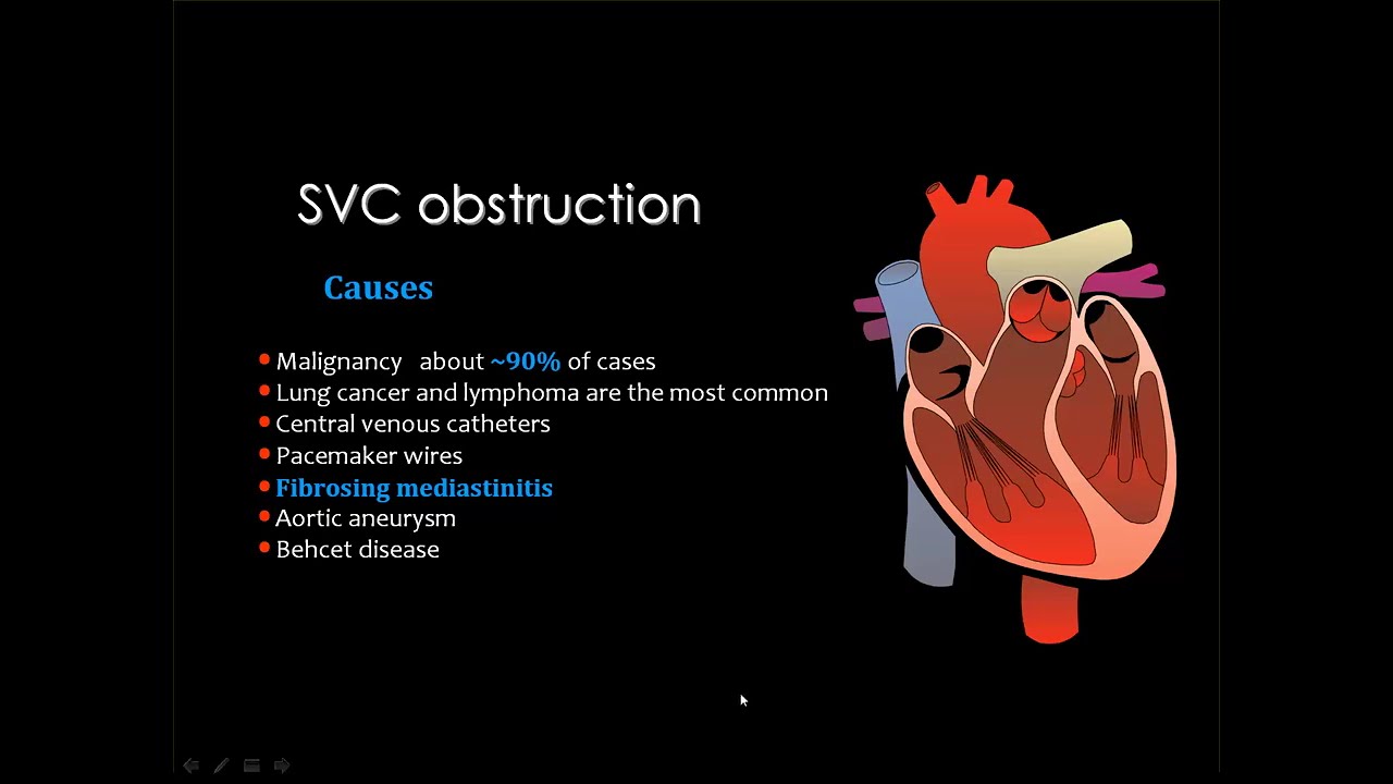 4  Venous system I   Peripheral vnins,IVC,SVC