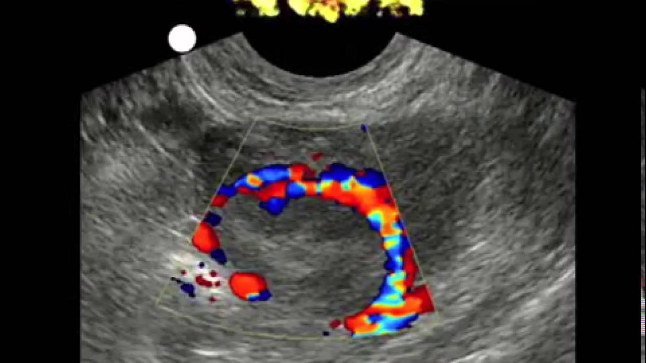 The Predictive Value of Decisive and Soft Ultrasound Criteria for Ectopic  Pregnancy Identification in 321 Preoperative Cases Pr