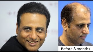 Hair Transplant Clinic in Mumbai at Eugenix Hair Sciences, India