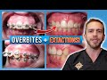 Braces Overbite Treatment! [BEFORE & AFTER]