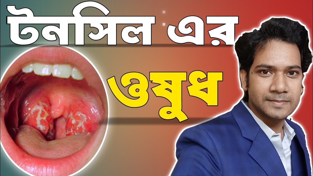 টনসিলের সমস্যা ও সমাধান | টনসিলের হোমিওপ্যাথি চিকিৎসা |