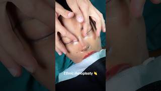 Ethnic Rhinoplasty With Rib Cartilage 👏👏👏