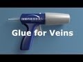 Instant superglue for varicose veins  venaseal tm by sapheon