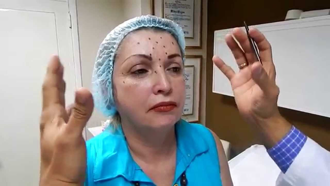 Aplicación de Botox - Dr. Jorge Azocar