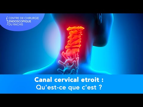 Vidéo: Canal Cervical - Traitement Du Canal Cervical Avec Des Remèdes Et Des Méthodes Populaires