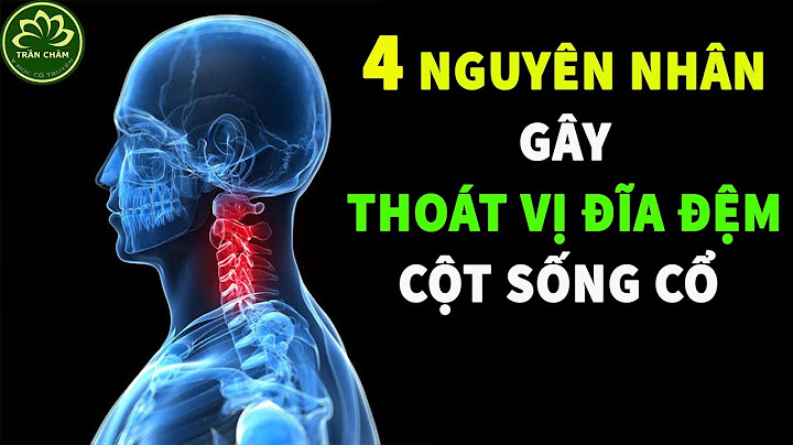 Nguyên nhân gây thoát vị đĩa đệm cột sống cổ