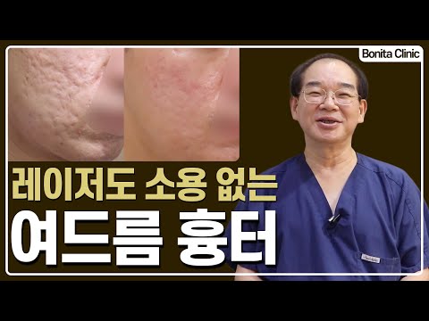 여드름 치료한다고 약먹고, 레이저 치료를 하다 패임이 더 심해지신 환자분은 이렇게 치료했습니다. [보니따클리닉 정광섭 대표원장]