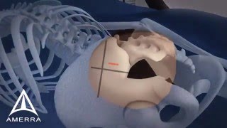 Фиксация крестцово-подвздошного сочленения винтовой системой Samba Screw System(Смотрите видео и читайте статьи по хирургии костной ткани на сайте http://костная-пластика.рф/ Это видео демон..., 2016-04-04T09:20:05.000Z)
