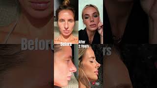 Rhinoplasty Transformation in Turkey ✨