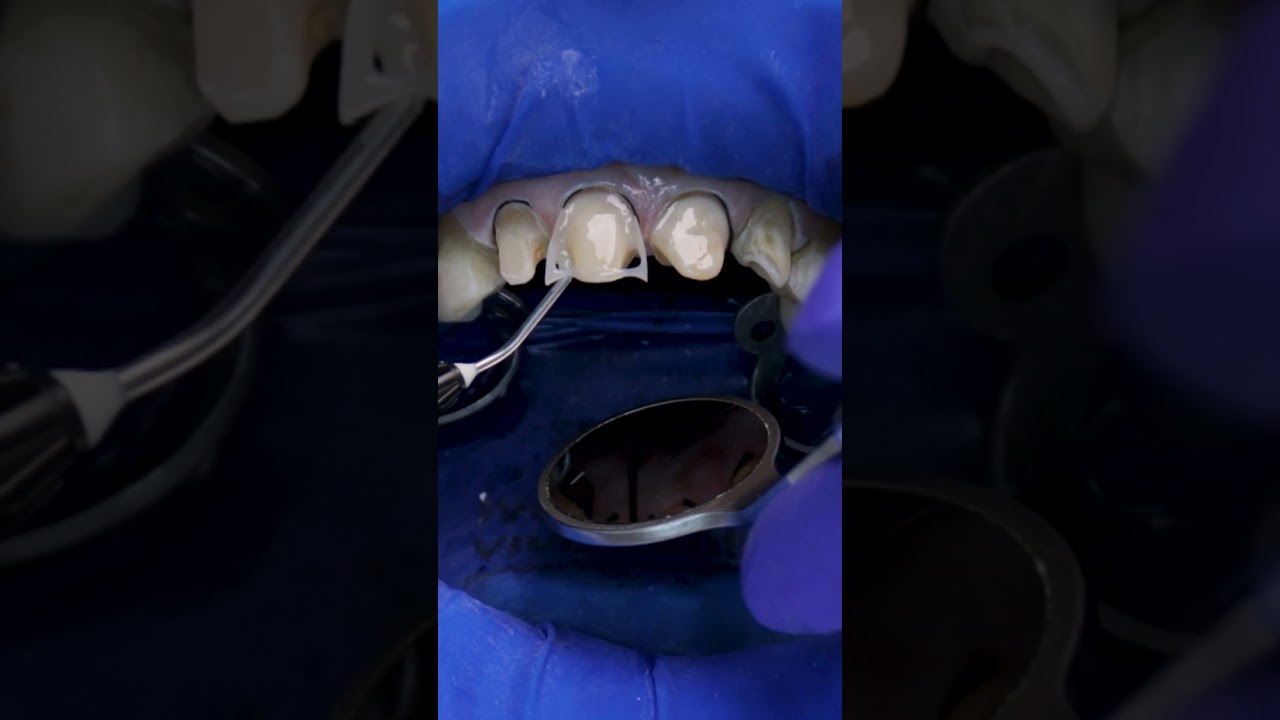 Flow-техника| Реставрация зубов текучими композитами #стоматология #шортс #зубы #виниры