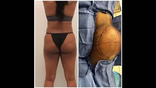 Butt Lift with Fat Grafting at Body by Ravi