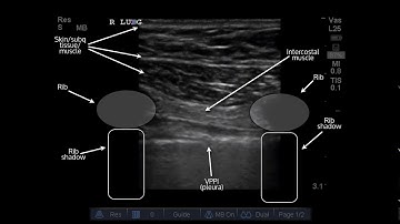Ultrasound of Pneumothorax