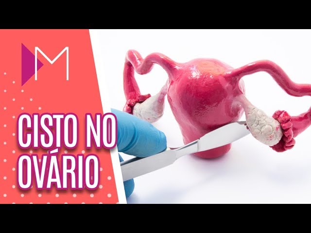 A maior remoção de cisto de ovário já registrado aconteceu no México