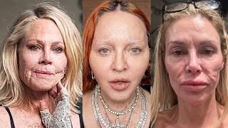 20 Celebrities Who Went Too Far With Plastic Surgery | Before & After Photos 2026