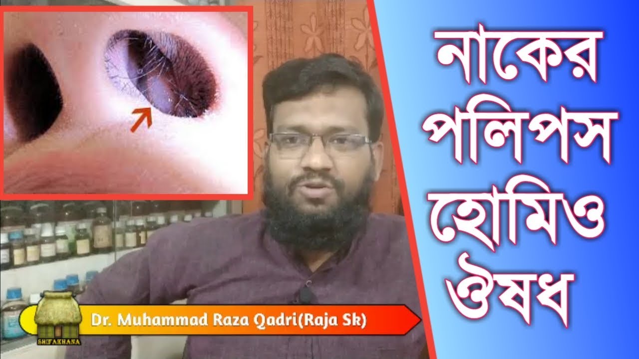 নাকের অর্বুদ পলিপাস এর হোমিওপ্যাথি ঔষধ | Nasal polyps homeopathy treatment in bangla