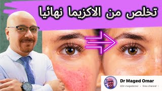 شاهد علاج الاكزيما والتهاب الجلد التحسسي  نهائيا وما لا تعرفه عن الاكزيما اسبابها وانواعها والعلاج