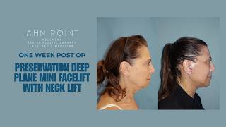 1-Week Recovery | Preservation Deep Plane Mini Facelift & Neck Lift